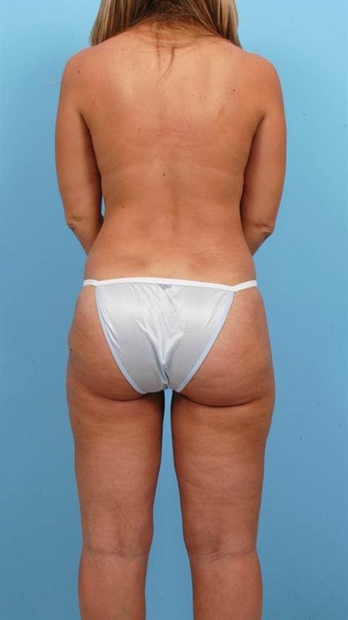 Liposuction After Photo | Miami, FL | Baker Plastic Surgery