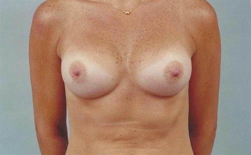 Breast Augmentation After Photo | Miami, FL | Baker Plastic Surgery