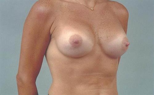 Breast Augmentation After Photo | Miami, FL | Baker Plastic Surgery