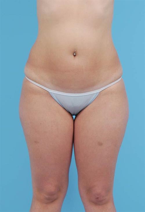 Liposuction Before Photo | Miami, FL | Baker Plastic Surgery