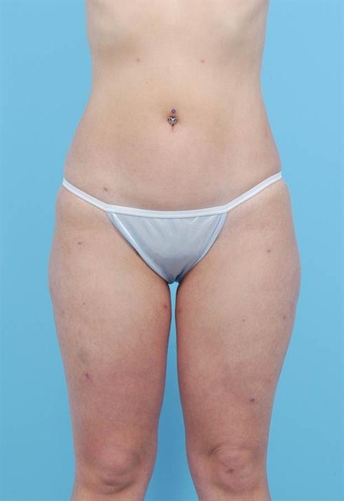 Liposuction After Photo | Miami, FL | Baker Plastic Surgery