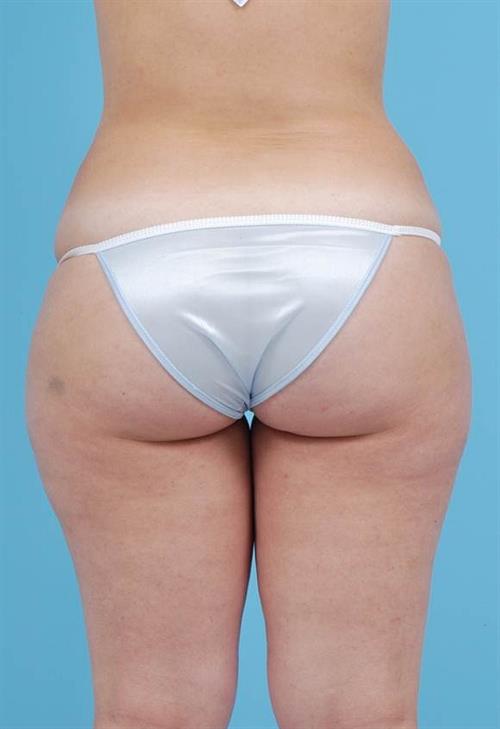 Liposuction Before Photo | Miami, FL | Baker Plastic Surgery