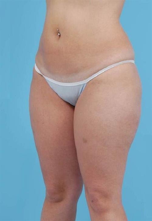 Liposuction Before Photo | Miami, FL | Baker Plastic Surgery