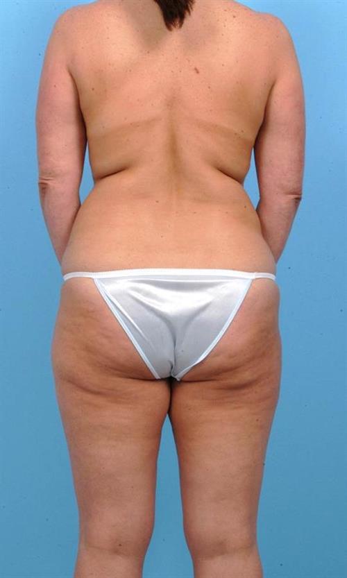 Liposuction Before Photo | Miami, FL | Baker Plastic Surgery