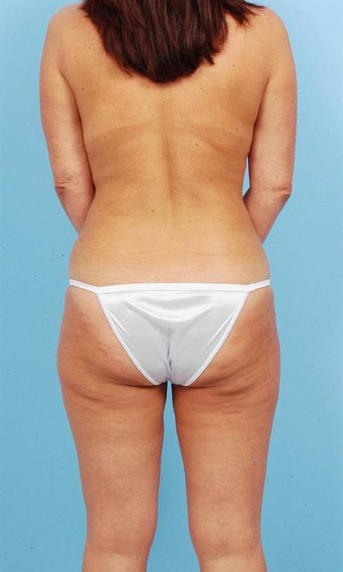 Liposuction After Photo | Miami, FL | Baker Plastic Surgery