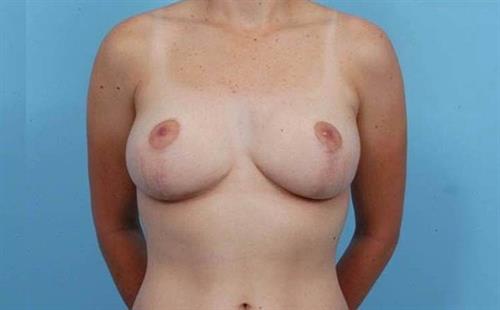 Breast Reduction After Photo | Miami, FL | Baker Plastic Surgery