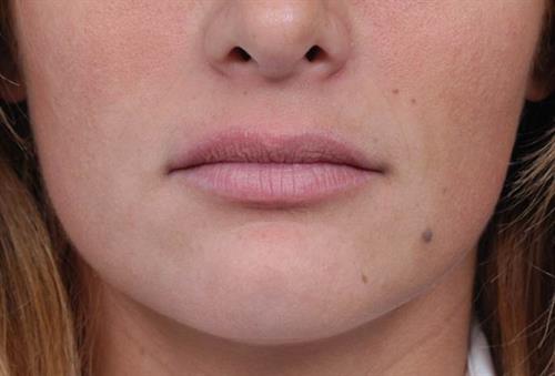 Lip Augmentation Before Photo | Miami, FL | Baker Plastic Surgery