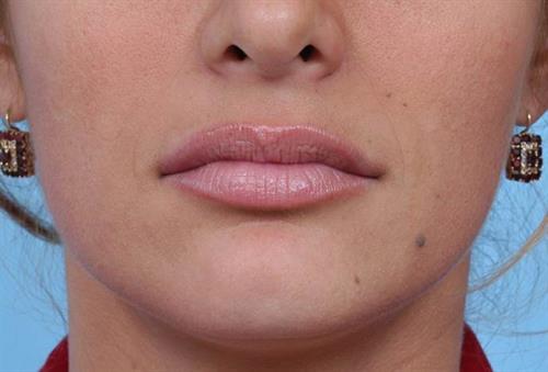 Lip Augmentation After Photo | Miami, FL | Baker Plastic Surgery