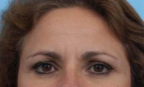 BOTOX®, Dysport® & XEOMIN® Before Photo | Miami, FL | Baker Plastic Surgery