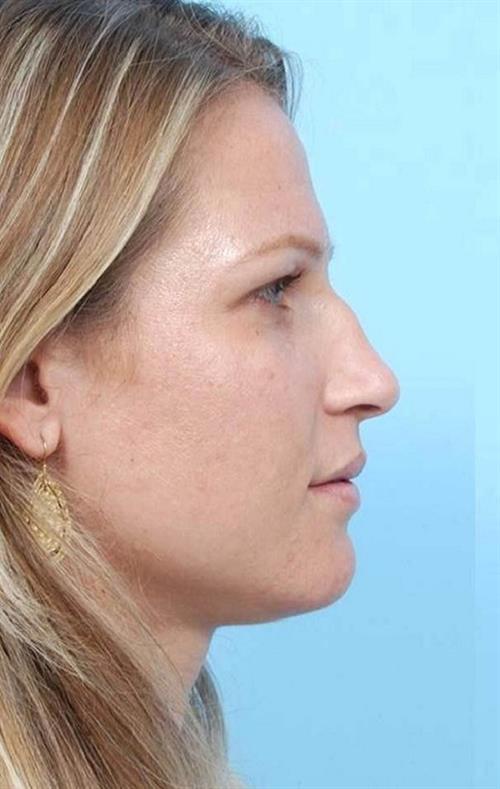 Rhinoplasty Before Photo | Miami, FL | Baker Plastic Surgery