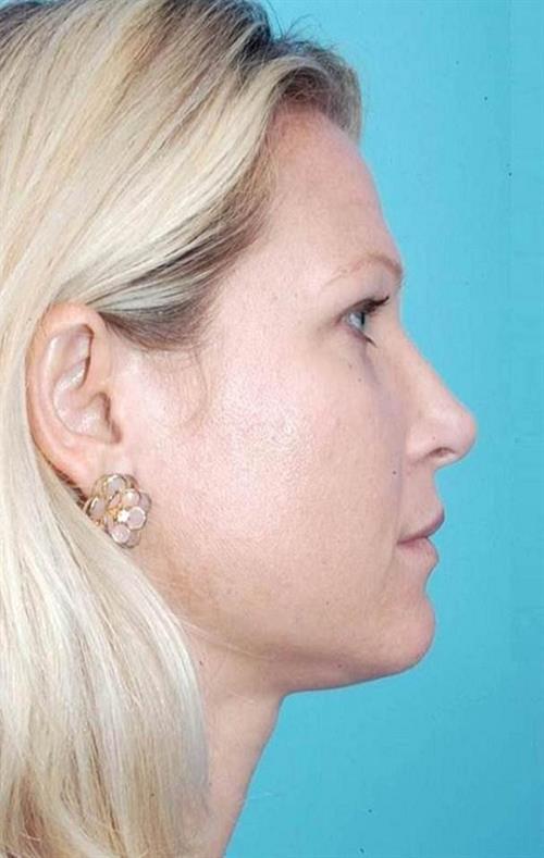 Rhinoplasty After Photo | Miami, FL | Baker Plastic Surgery