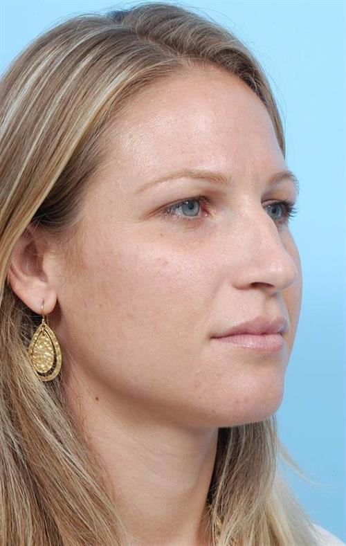 Rhinoplasty Before Photo | Miami, FL | Baker Plastic Surgery