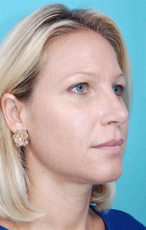 Rhinoplasty After Photo | Miami, FL | Baker Plastic Surgery