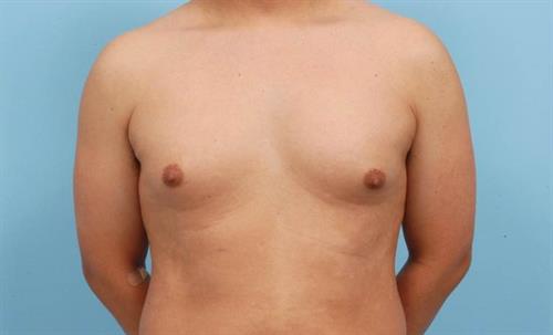 Gynecomastia Before Photo | Miami, FL | Baker Plastic Surgery