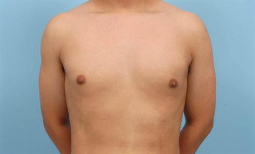 Gynecomastia After Photo | Miami, FL | Baker Plastic Surgery