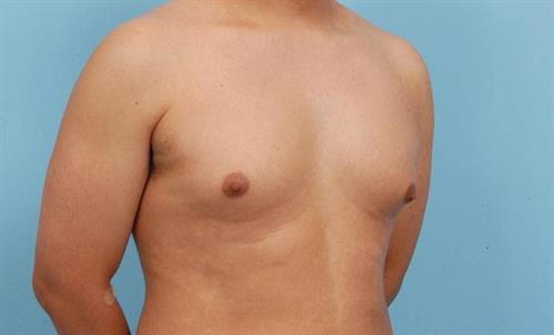 Gynecomastia Before Photo | Miami, FL | Baker Plastic Surgery