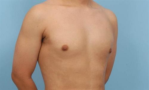 Gynecomastia After Photo | Miami, FL | Baker Plastic Surgery