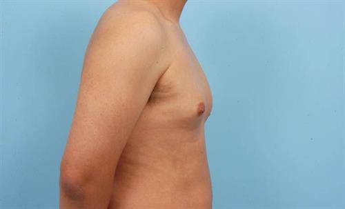 Gynecomastia Before Photo | Miami, FL | Baker Plastic Surgery