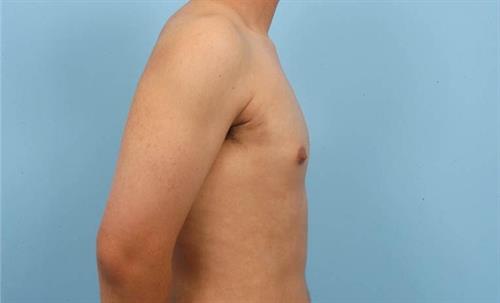 Gynecomastia After Photo | Miami, FL | Baker Plastic Surgery