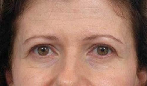 Eyelid Surgery Before Photo | Miami, FL | Baker Plastic Surgery