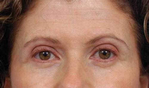 Eyelid Surgery After Photo | Miami, FL | Baker Plastic Surgery