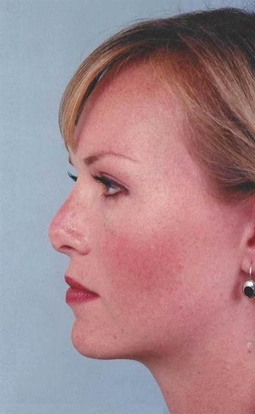 Rhinoplasty Before Photo | Miami, FL | Baker Plastic Surgery