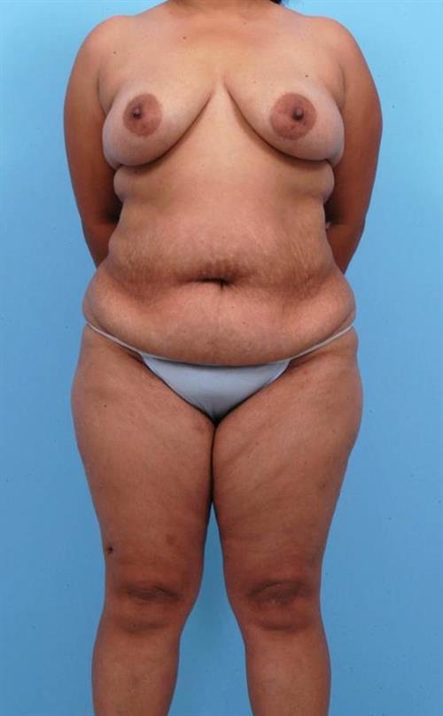 Tummy Tuck Before Photo | Miami, FL | Baker Plastic Surgery