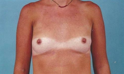 Breast Augmentation Before Photo | Miami, FL | Baker Plastic Surgery