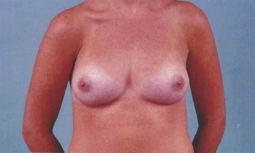 Breast Augmentation After Photo | Miami, FL | Baker Plastic Surgery