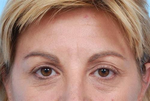 BOTOX®, Dysport® & XEOMIN® Before Photo | Miami, FL | Baker Plastic Surgery