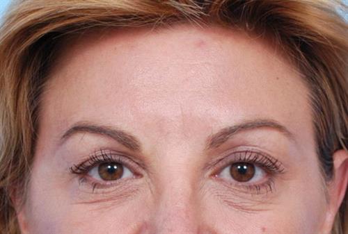 BOTOX®, Dysport® & XEOMIN® After Photo | Miami, FL | Baker Plastic Surgery