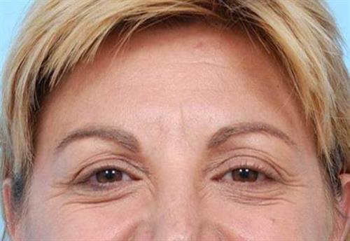 BOTOX®, Dysport® & XEOMIN® Before Photo | Miami, FL | Baker Plastic Surgery