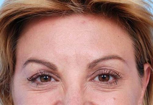 BOTOX®, Dysport® & XEOMIN® After Photo | Miami, FL | Baker Plastic Surgery