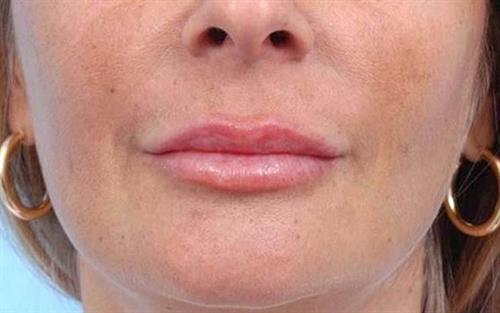 Lip Augmentation After Photo | Miami, FL | Baker Plastic Surgery