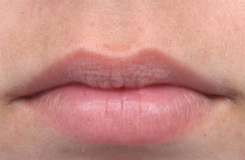 Lip Augmentation Before Photo | Miami, FL | Baker Plastic Surgery