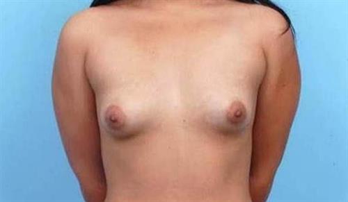 Breast Augmentation Before Photo | Miami, FL | Baker Plastic Surgery