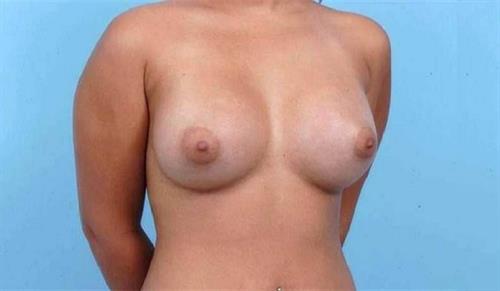 Breast Augmentation After Photo | Miami, FL | Baker Plastic Surgery