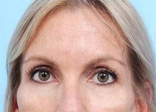 Injectable Fillers Before Photo | Miami, FL | Baker Plastic Surgery