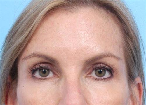 Injectable Fillers After Photo | Miami, FL | Baker Plastic Surgery