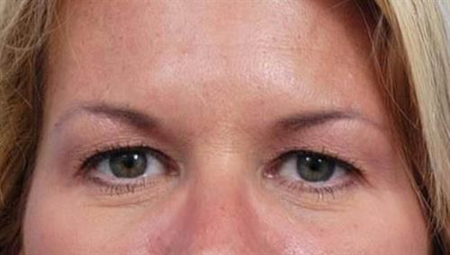 Eyelid Surgery Before Photo | Miami, FL | Baker Plastic Surgery