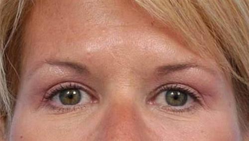 Eyelid Surgery After Photo | Miami, FL | Baker Plastic Surgery