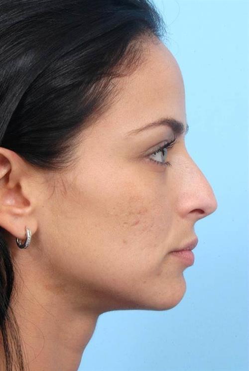 Rhinoplasty Before Photo | Miami, FL | Baker Plastic Surgery