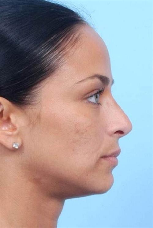 Rhinoplasty After Photo | Miami, FL | Baker Plastic Surgery