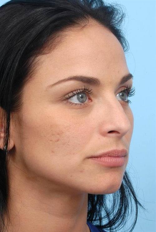 Rhinoplasty Before Photo | Miami, FL | Baker Plastic Surgery