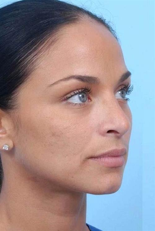 Rhinoplasty After Photo | Miami, FL | Baker Plastic Surgery