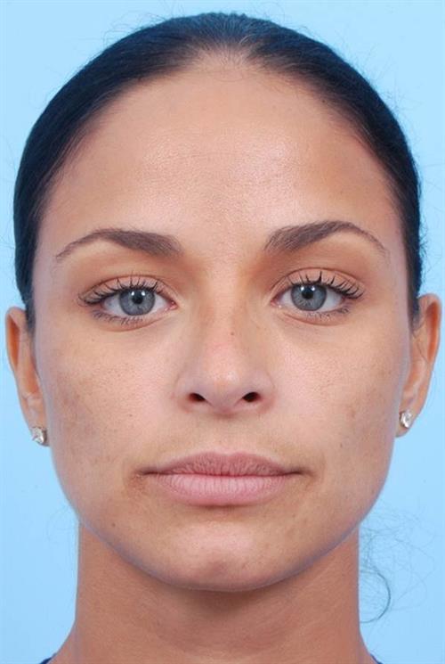 Rhinoplasty After Photo | Miami, FL | Baker Plastic Surgery