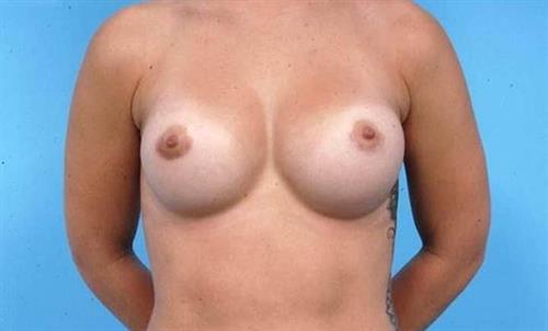 Breast Revision After Photo | Miami, FL | Baker Plastic Surgery