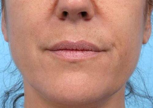 Lip Augmentation Before Photo | Miami, FL | Baker Plastic Surgery