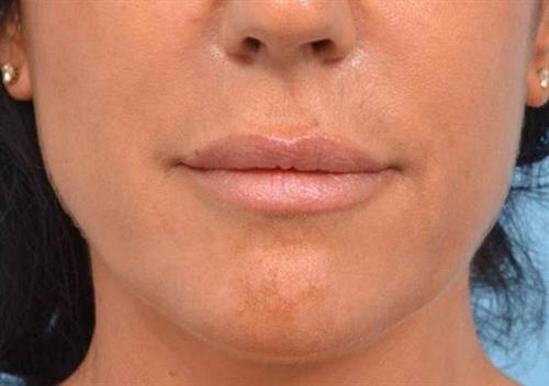 Lip Augmentation After Photo | Miami, FL | Baker Plastic Surgery