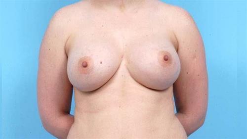 Breast Revision Before Photo | Miami, FL | Baker Plastic Surgery
